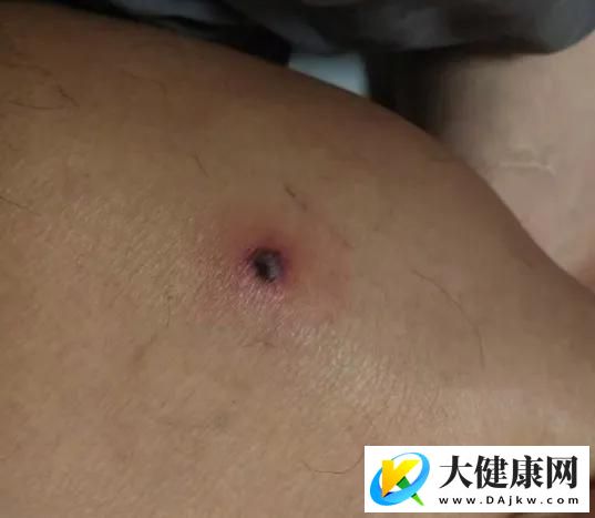 被小虫子咬后，出现这种黑色焦痂，千万别大意！