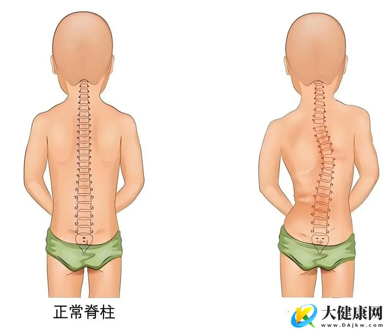 脊柱科医生提醒：勿将脊柱侧弯简单归咎于姿势不良