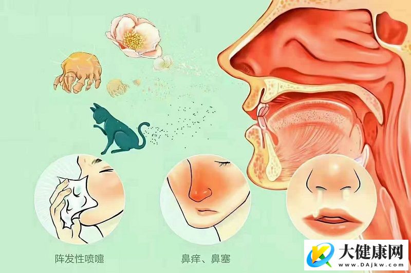 过敏性鼻炎反复难愈怎么办？专家详解规范治疗与复方制剂新方案